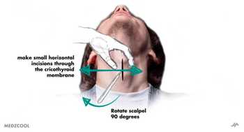 Emergency Cricothyroidotomy | Nucleotype