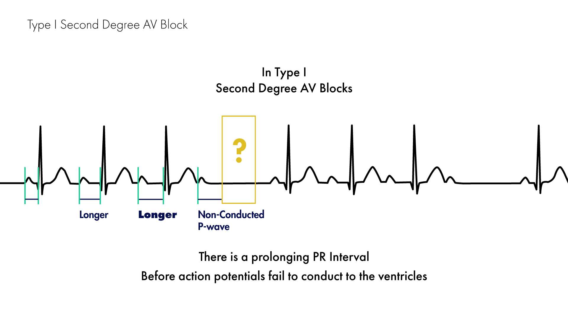 Mobitz Type I Versus Type II Second Degree Heart Block Nucleotype