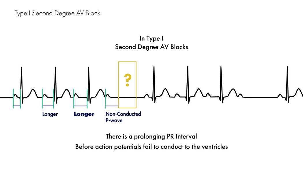 Mobitz Type I Versus Type II Second Degree Heart Block | Nucleotype