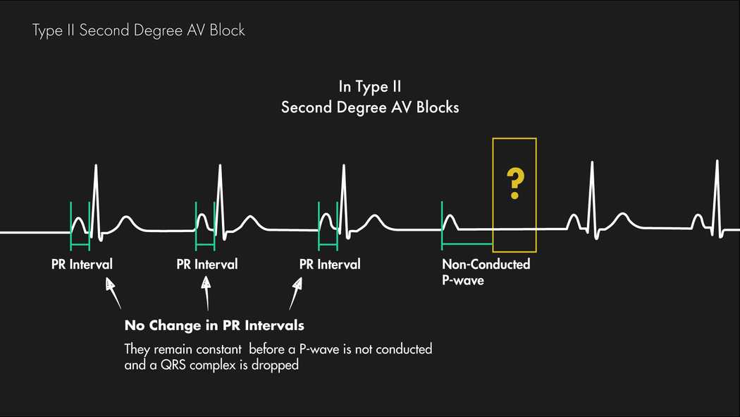 mobitz-type-i-versus-type-ii-second-degree-heart-block-nucleotype