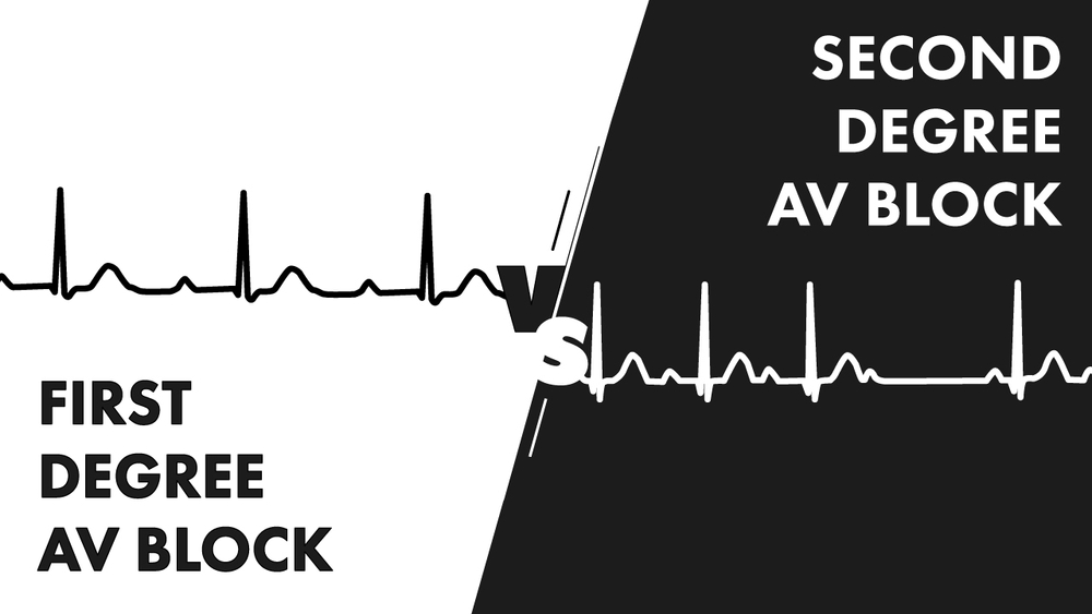 first-versus-second-degree-heart-block-nucleotype