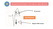 Sgarbossa Criteria | Nucleotype