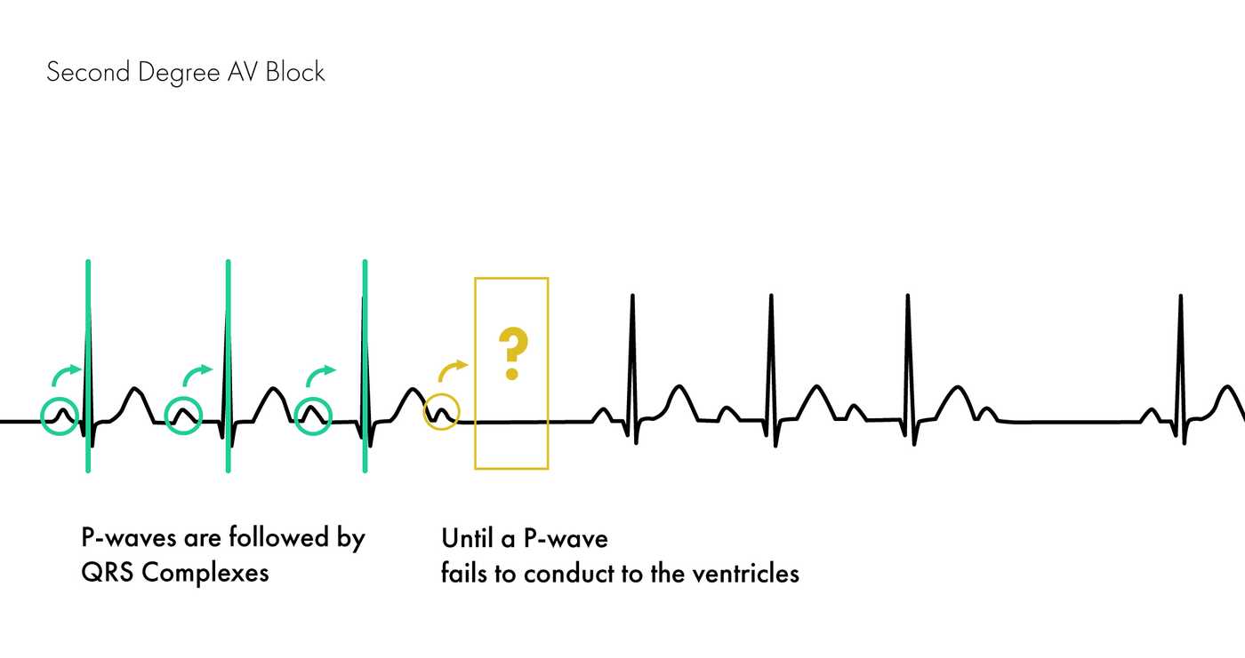 Mobitz Type I Versus Type II Second Degree Heart Block | Nucleotype