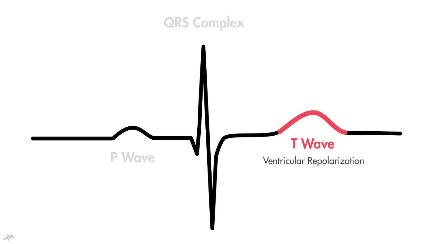 r-wave-progression-normal-chest-lead-ecg-shows-an-grepmed